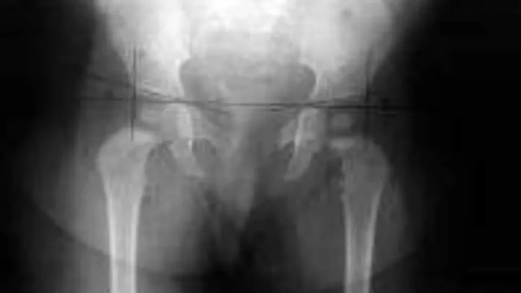 Justiça limita ressarcimento em ação de cirurgia de R$ 239 mil do SUS