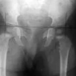 Justiça limita ressarcimento em ação de cirurgia de R$ 239 mil do SUS