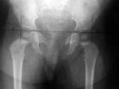Justiça limita ressarcimento em ação de cirurgia de R$ 239 mil do SUS