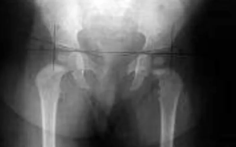 Justiça limita ressarcimento em ação de cirurgia de R$ 239 mil do SUS