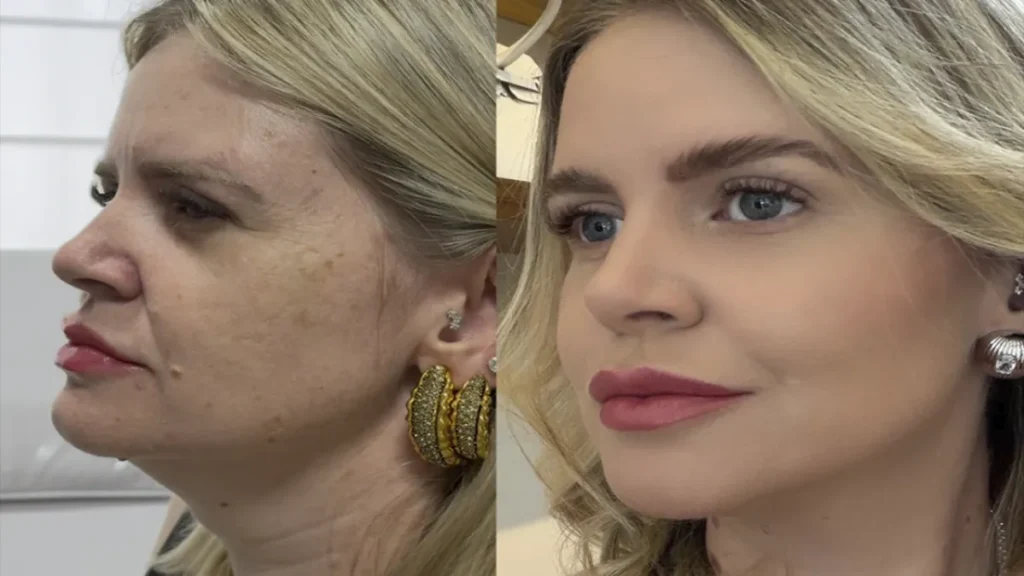 Estética regenerativa: o novo luxo que vai além dos preenchedores