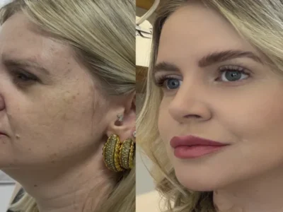 Estética regenerativa: o novo luxo que vai além dos preenchedores