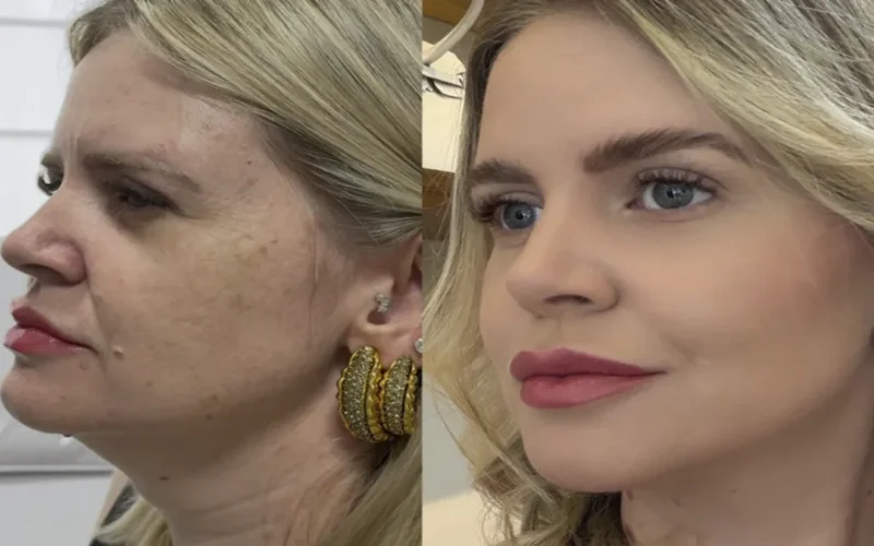 Estética regenerativa: o novo luxo que vai além dos preenchedores